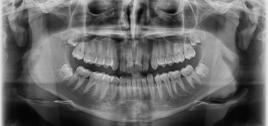 Radiografia Panorâmica: Visão Completa da Arcada Dentária e Maxilares