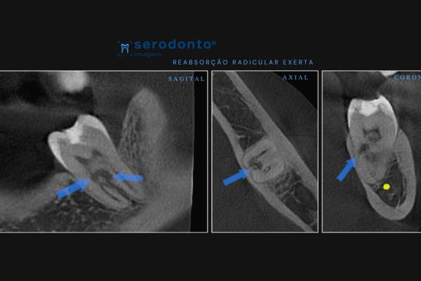 reabsorcao-radicular-externa-avaliando-a-extensao-com-tomografia