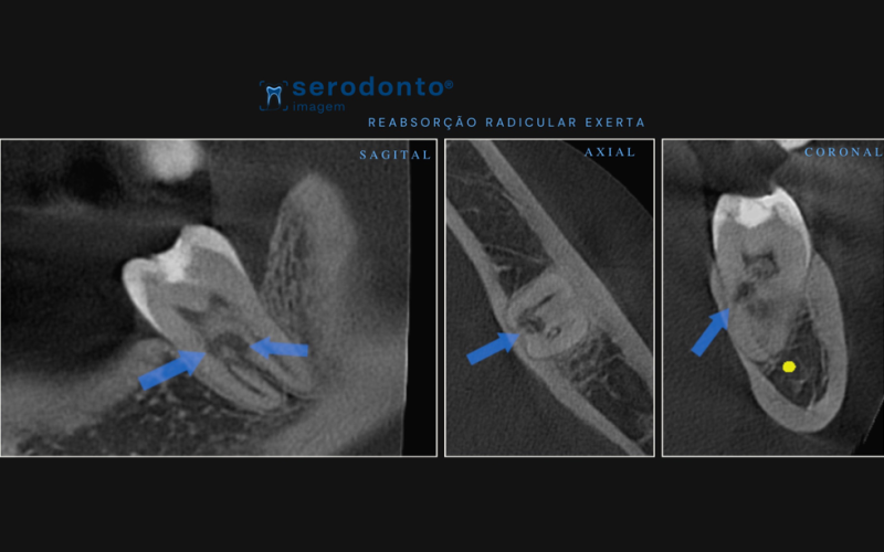 reabsorcao-radicular-externa-avaliando-a-extensao-com-tomografia